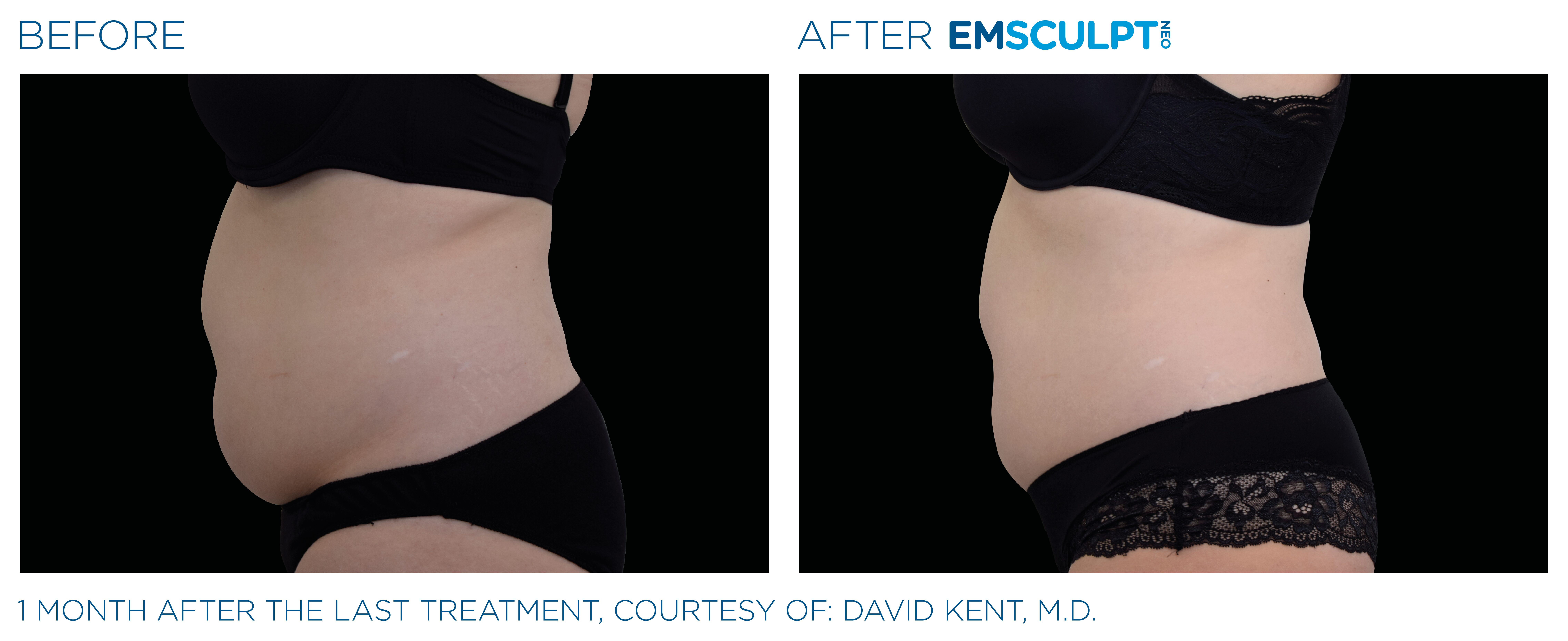 Emsculpt Neo Belly fat reduction treatment and body sculpting in seattle