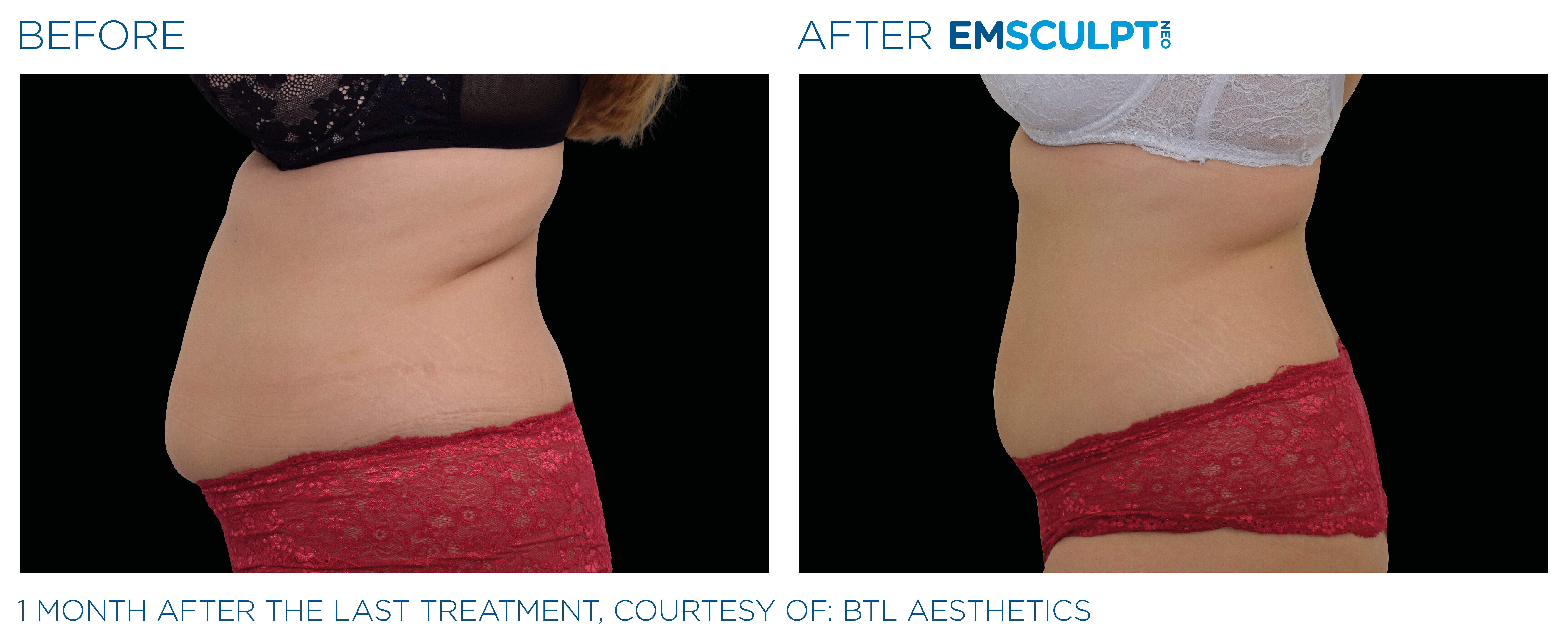 improve weight line and stronger core with emsculpt neo in seattle