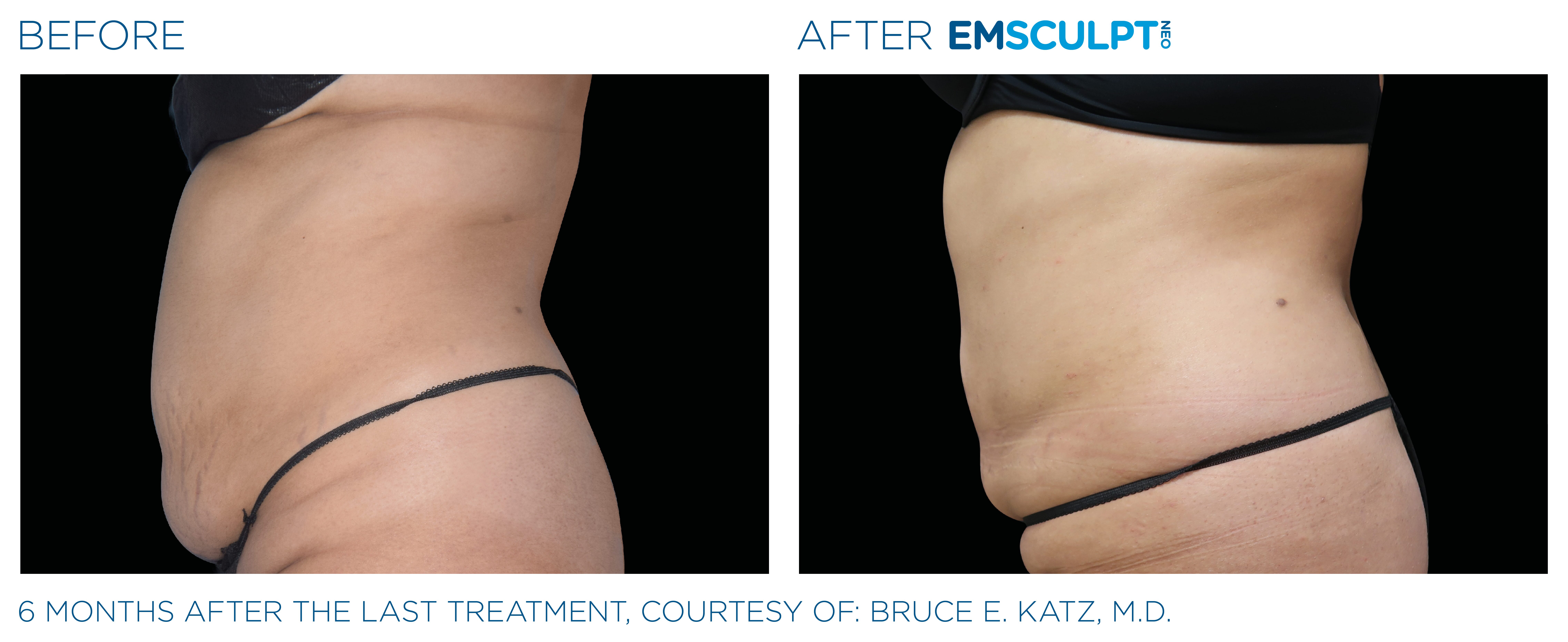 Lose weight and improve metabolism with emsculpt neo in seattle