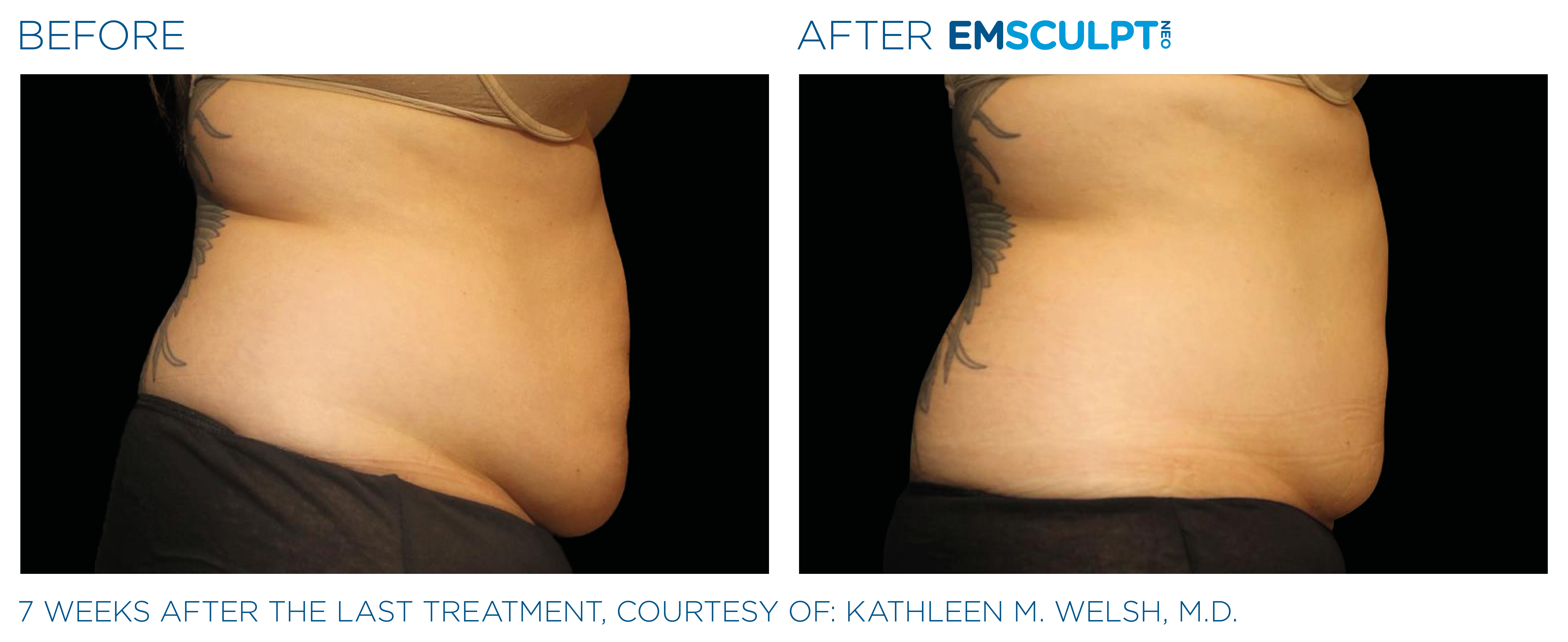 Reduce belly fat and strengthen core with Emsculpt Neo in Seattle