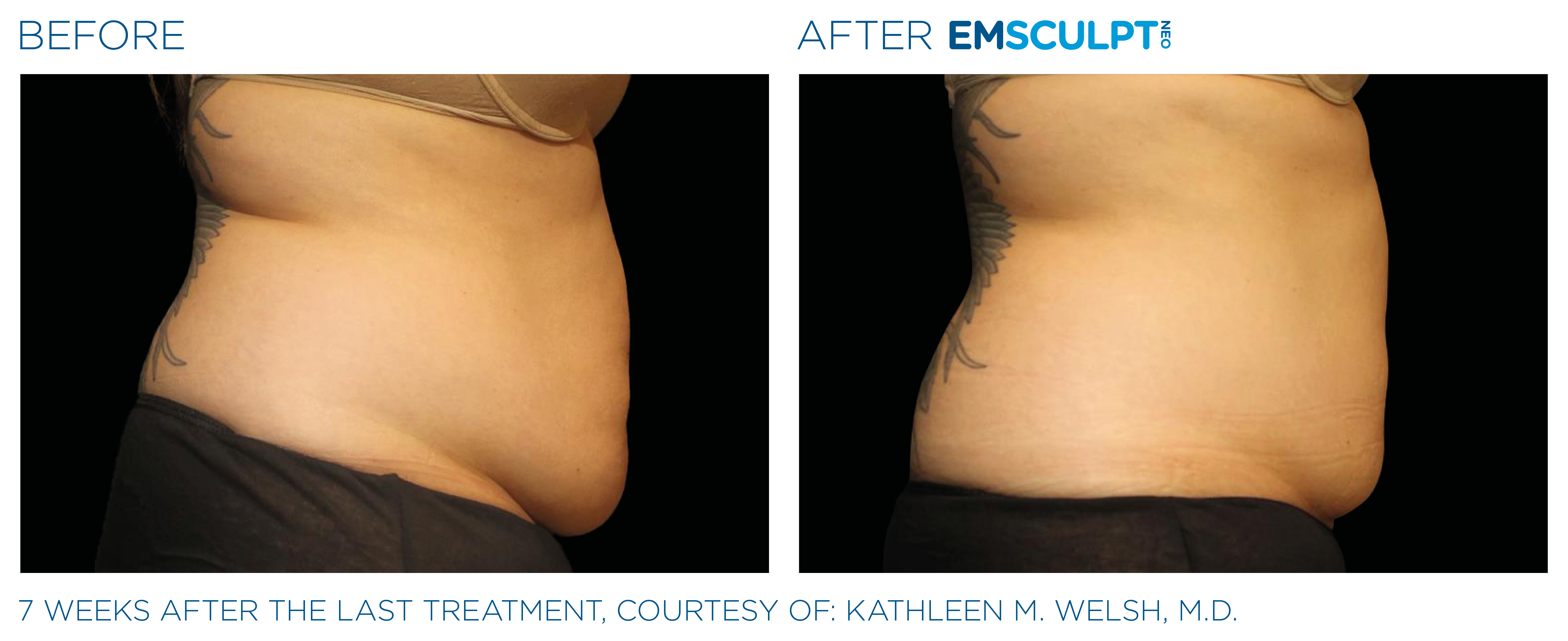 Emsculpt Neo® is a revolutionary body sculpting treatment that has taken  the world by storm. It is a non-invasive procedure that uses hi